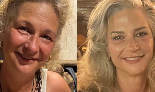 thread lift facial rejuvenation before after mississauga oakville